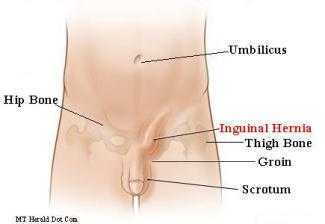inguinal-hernia